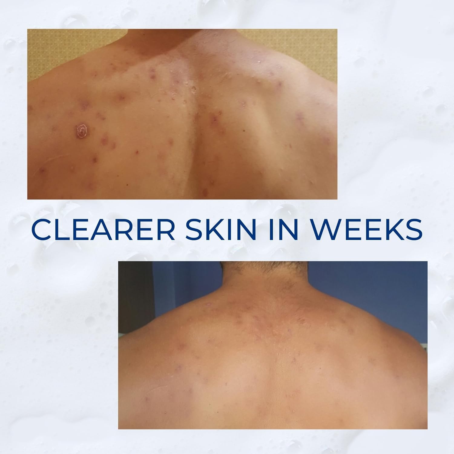 Body Acne Treatment Scrub: Helps Reduce Body Breakouts on Back, Chest, Shoulders, and Thighs - Back Acne Treatment for Men, Women, and Teens, Safe for Sensitive Skin (4 oz) - Image 3