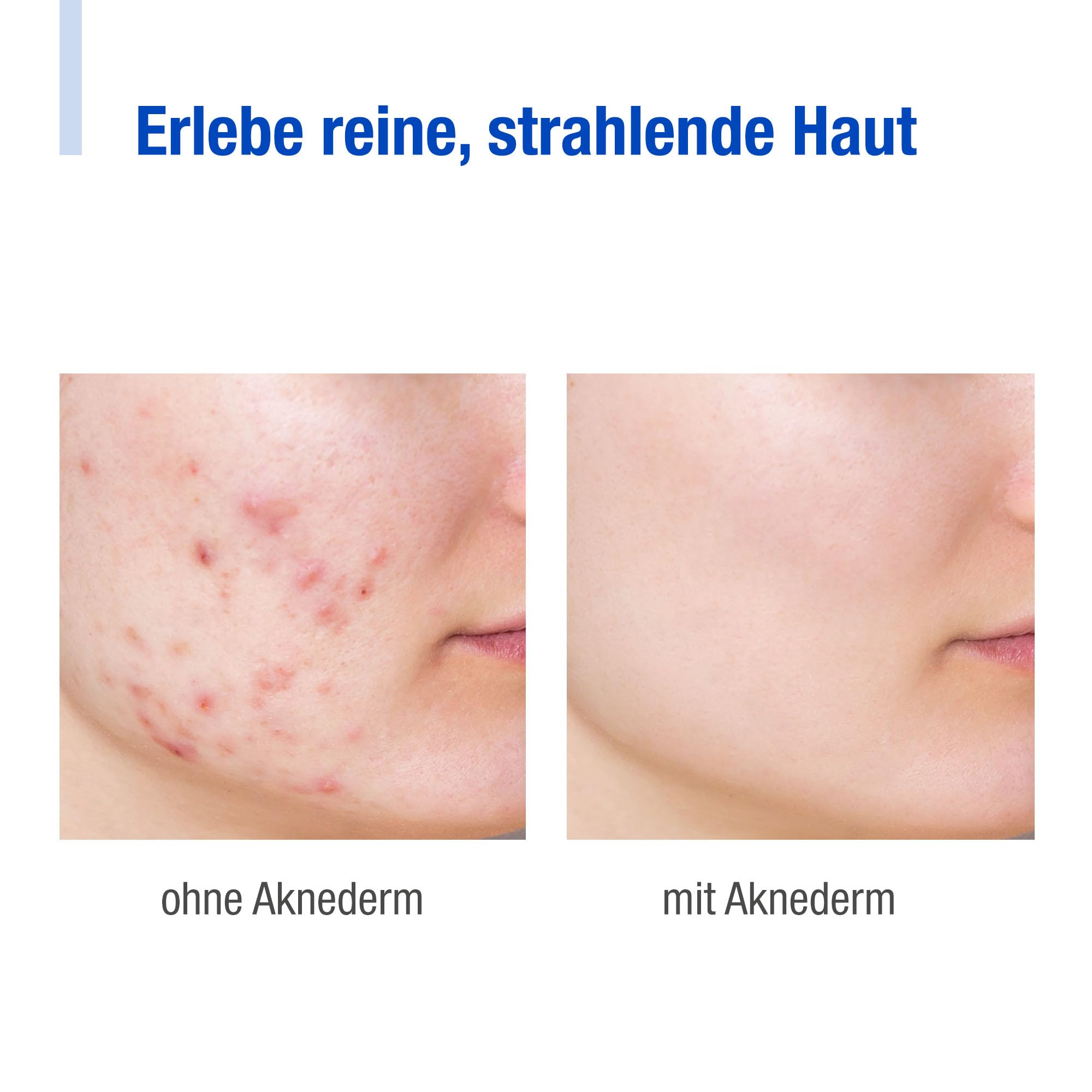 aknederm Tinktur 2x 50ml - mit Lactic Acid/Milchsäure (AHA) und Salizylsäure (BHA) - sanfte porentiefen Hautreinigung und Desinfektion - Zink Gesichtswasser für trockene/sensible & unreine Haut