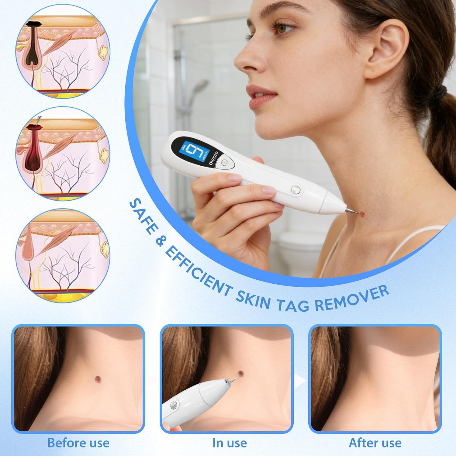 Wart and SkinTag Remover, Compact-Friendly Design for Home Use / CTS-15