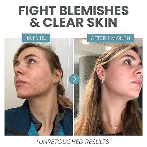 Miniatura 4 de Vitamina C para la cara, suero para limpiar la piel con ácido salicílico, retinol, niacinamida y ácido hialurónico, aclarante de la piel, antiacné,