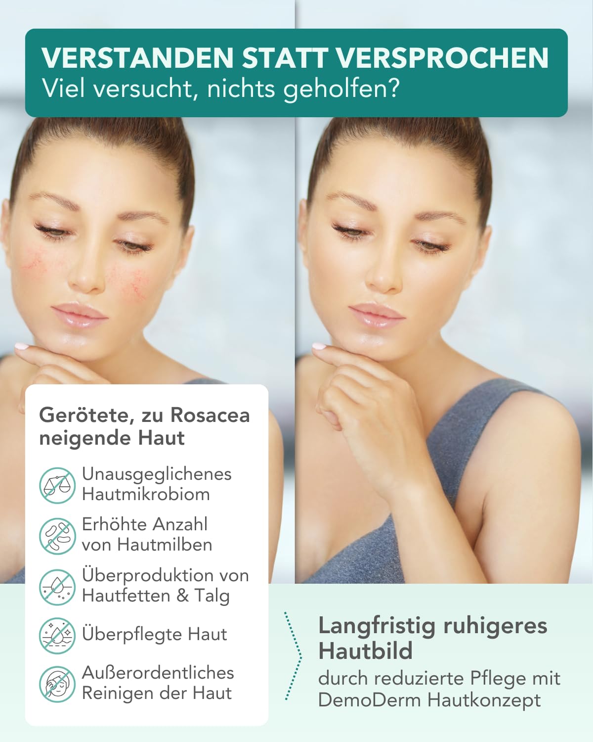 DemoDerm Rosacea Intensiv-Creme – beruhigende Systempflege bei empfindlicher, zu Rötungen neigender Haut | Mit Zink & Schwefel, Made in Germany (30 g)