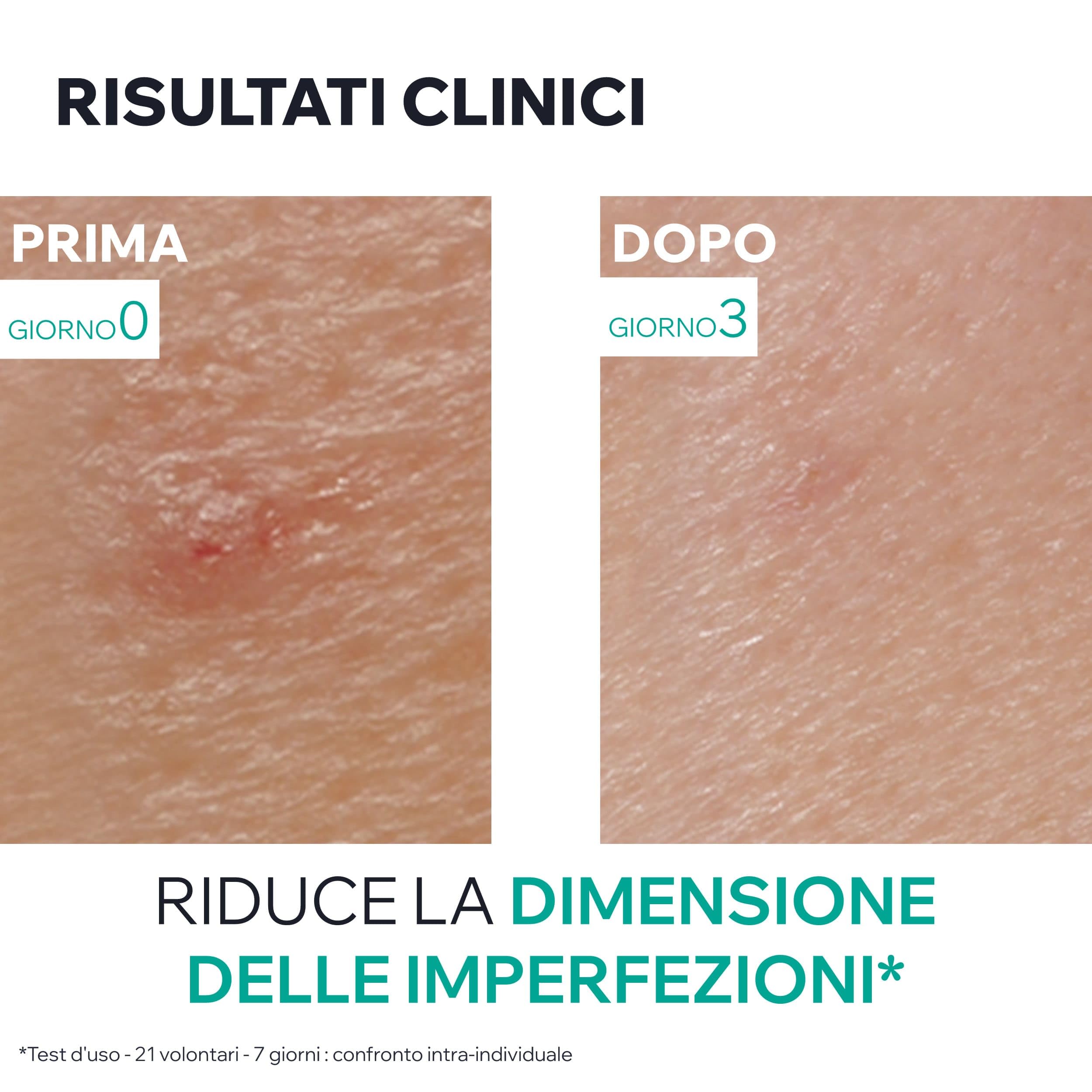 Uriage Hyseac Pasta SOS con Árbol del Té, Zinc y Arcilla Verde - Acelera la Maduración de las Imperfecciones de la Noche a la Mañana y Limita las Marcas en la Piel - Para Granos e imperfecciones.