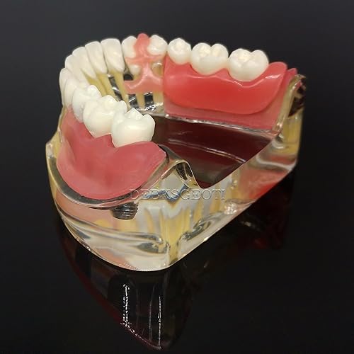 Miniatura 9 de Modelo de restauración de tipodonto con implantes dentales DEBKSGEOTI M6006 para prótesis sobreimplantes con 3 implantes, puente inferior,