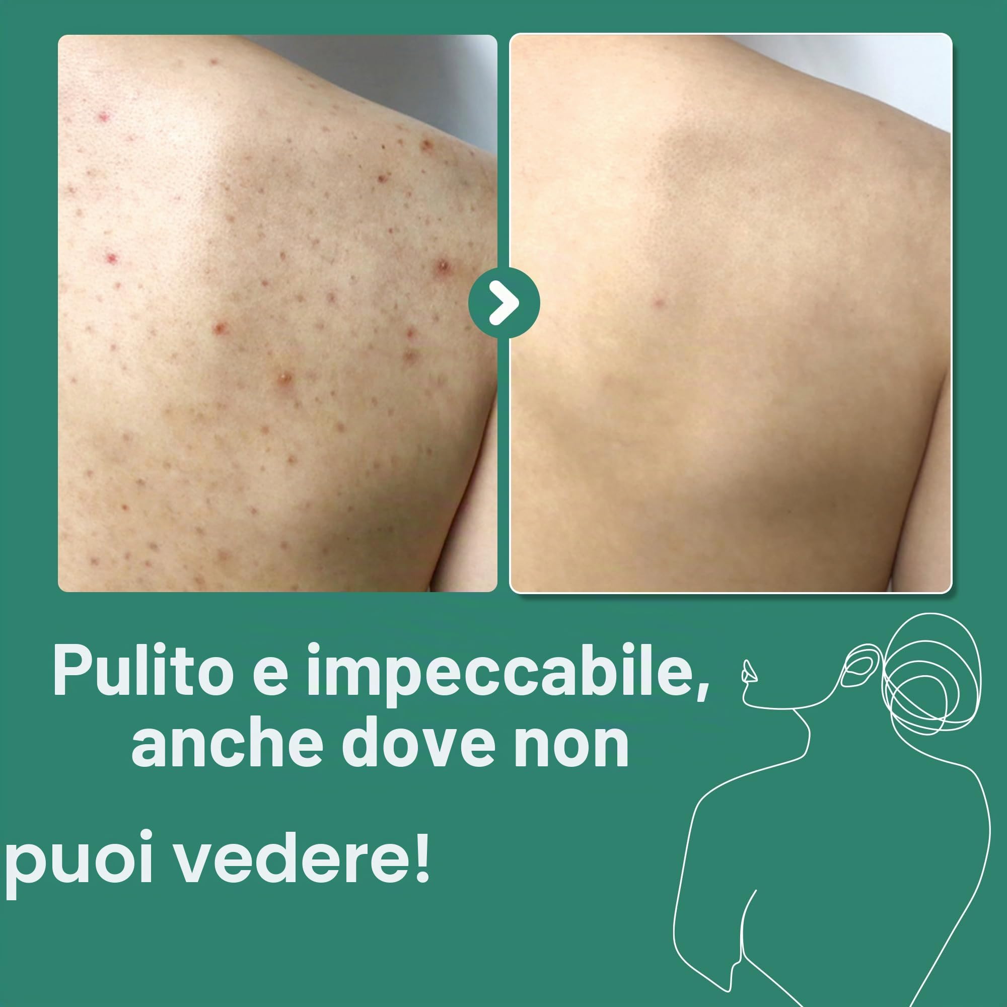 SOME BY MI AHA BHA PHA 30 Days Miracle Acne Clear Body Cleanser – 400ml – Detergente corpo quotidiano coreano con tea tree – Purifica il sebo e le impurità – Cura coreana