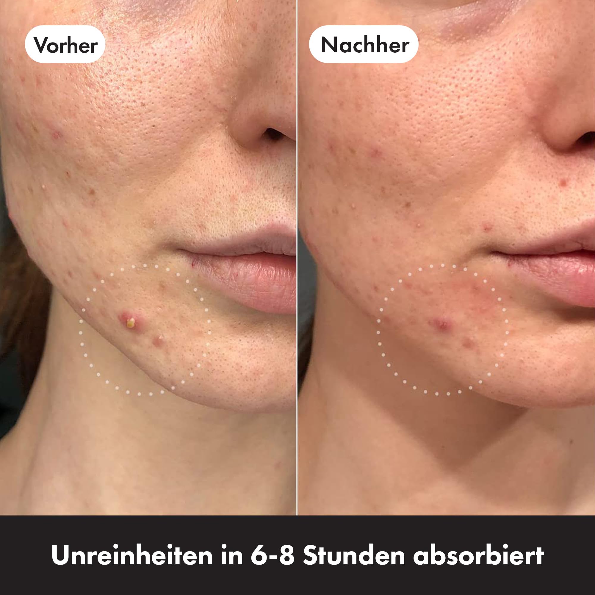 Hero Mighty Patch Invisible+ Pickel-Patches von Hero Cosmetics, klare Hydrokolloid-Pflaster zur Akne-Behandlung, 78 Stück