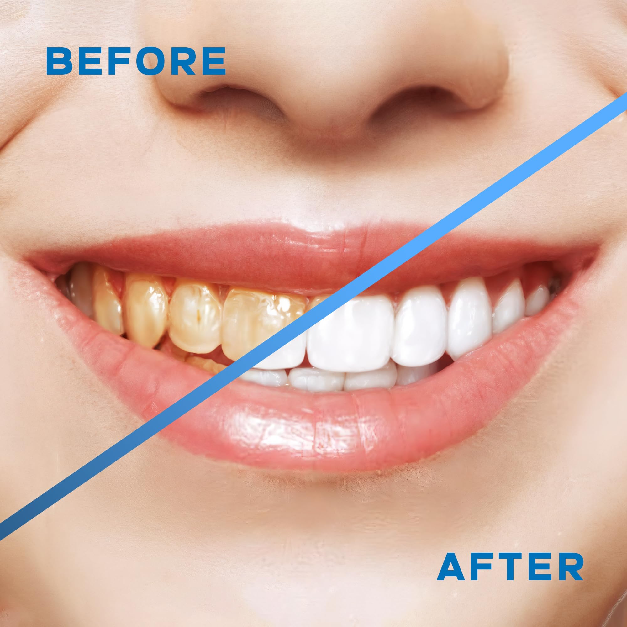 Idropulsore senza fili per la pulizia dei denti - Irrigatore orale con serbatoio staccabile da 300 ml con 5 punte e 5 modalità, impermeabile IPX7, plettro dentale ricaricabile USB per bretelle