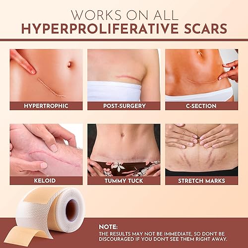 Miniatura 3 de Hojas de silicona para cicatrices  Cinta de silicona para cicatrices (rollo de 1.6 x 120 pulgadas  3M)  Eliminación de protuberancias queloides
