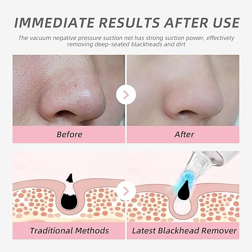 Miniatura 3 de Aspiradora de poros para eliminar puntos negros, extractor de limpiador facial, 4 cabezales de succión y 3 modos ajustables, interfaz de carga USB,