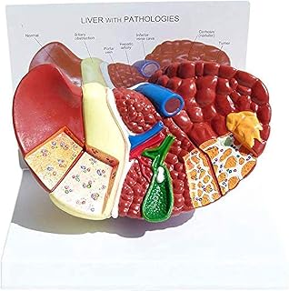 Liver Model Human Anatomical Model of The Liver, 3D Structure of The Pathology of The Liver, Visceral Scientific Anatomical Model, Size Natural Cancer for Medical