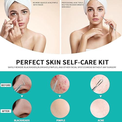 Miniatura 4 de WSYUB Herramienta para reventar espinillas, extractor de espinillas de acero inoxidable, pinzas WSYUB para puntos negros, kit de eliminación de acné