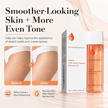 Stretch Mark Oil, Oil Stretch Mark & Scar Treatment, Boosts Collagen, Lifts Skin, Improves Stretch Marks, Scars & Uneven Tone,125ml