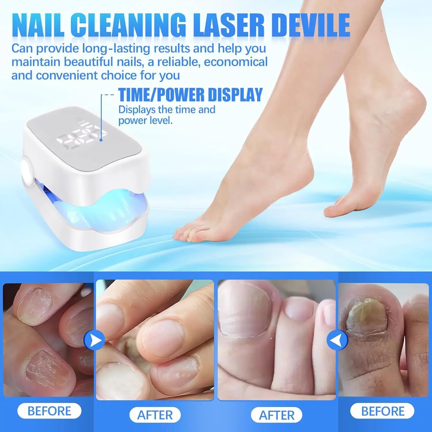 Dispositivo Laser dei Funghi Unghie Indolore,Trattamento Veloce Intensivo del Fungo dell'unghia, Luce Blu 470nm e Infrarossa 905nm per Chiodi Multipli Sicuro e Affidabile