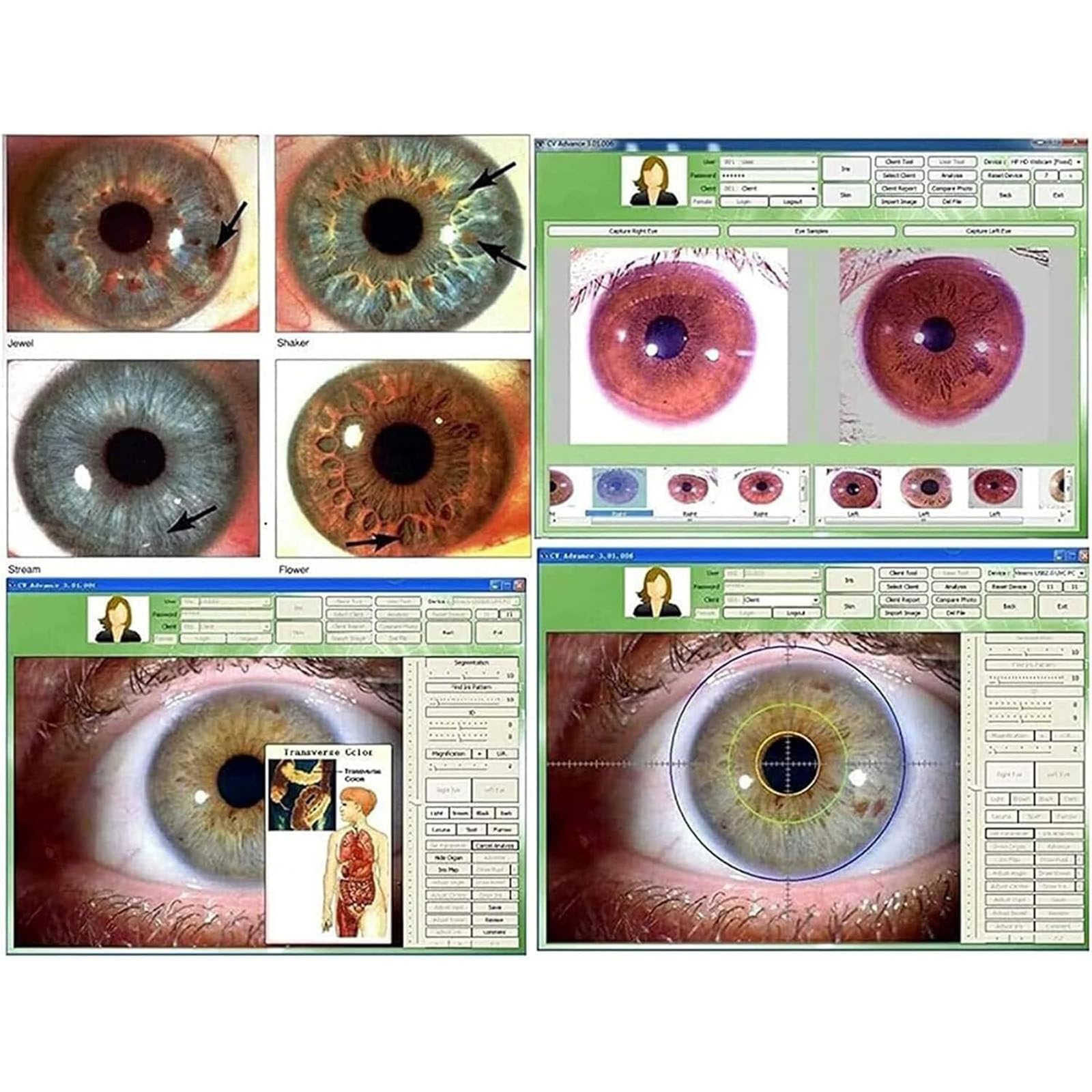 Telecamera iridoscopica medicale,Analizzatore Dell'iride Iridologia,USB iridoscopio Telecamera iridologica,Iris Software per diagnosi Eye