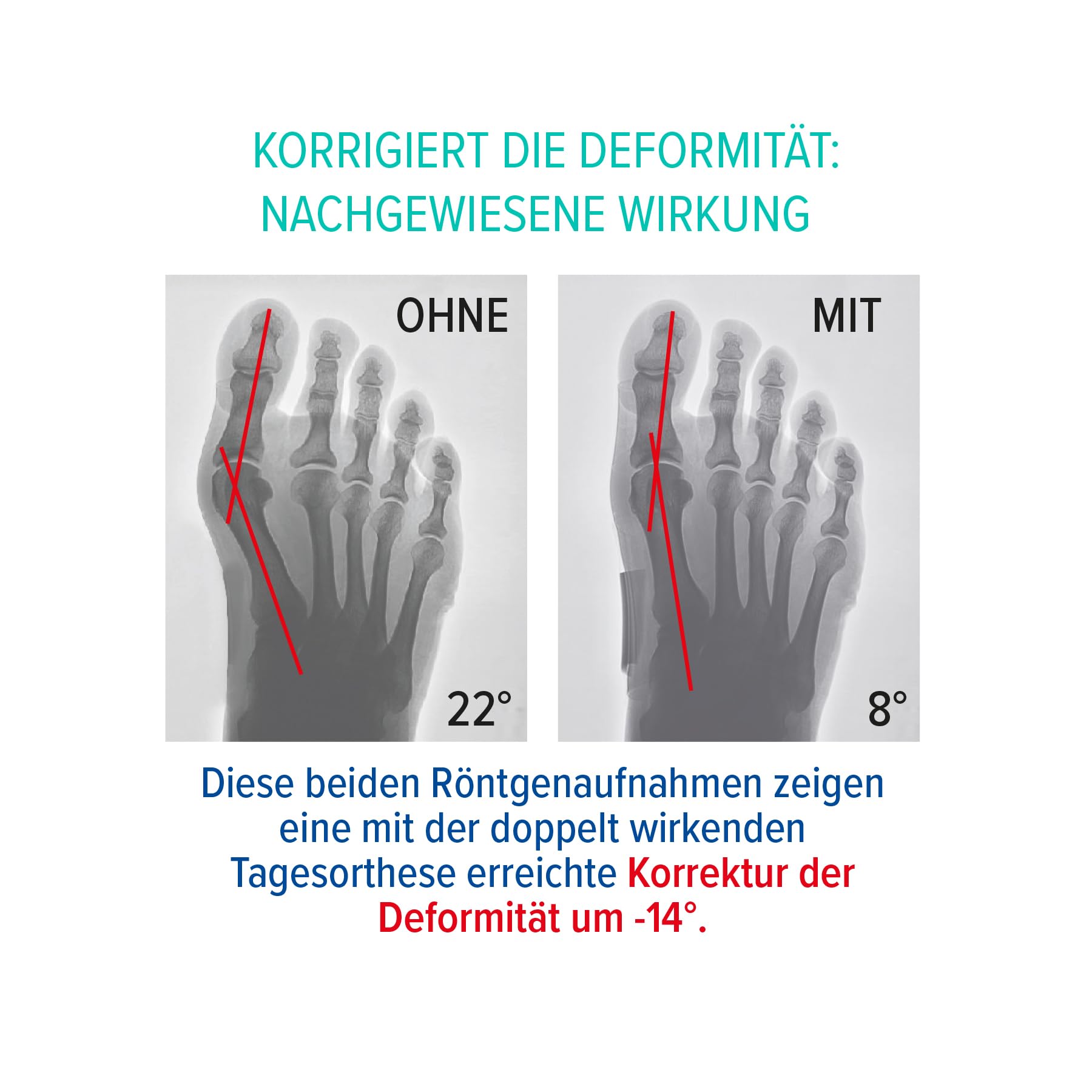 Epitact | Hallux Valgus Flexible Korrekturbandage Für Den Tag Begrenzt Die Entwicklung Des Hallux Valgus & Lindert Schmerzen Während Aktiven Tätigkeiten Am Tag Für Beide Füße (M)