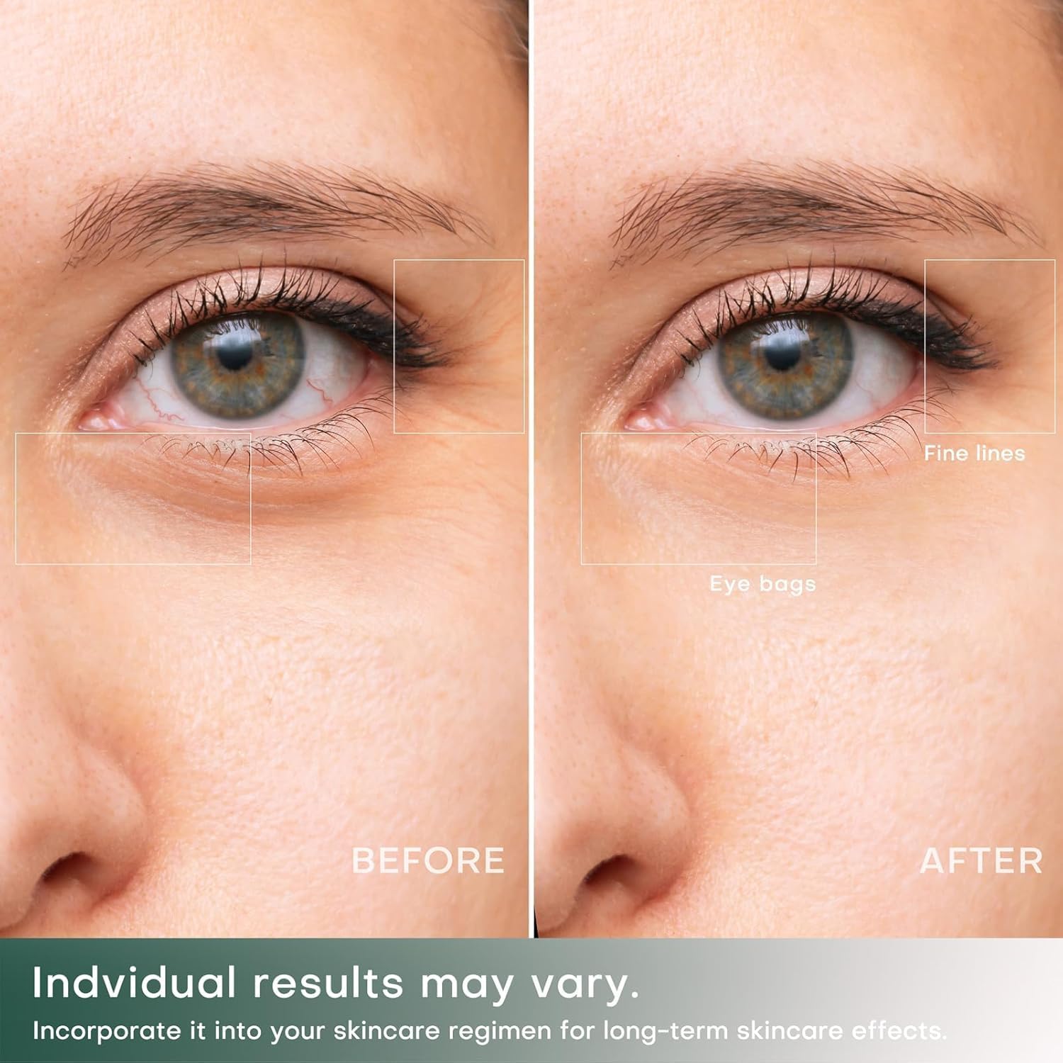 RF Radio Frequency Eye Device | 2 in 1 Eye Anti Aging Device | Under Eye Bags Treatment | Eye Bags | Eye Puffiness | Fine Line | Wrinkle Reducing - Professional RF Eye Skin Care Beauty Device