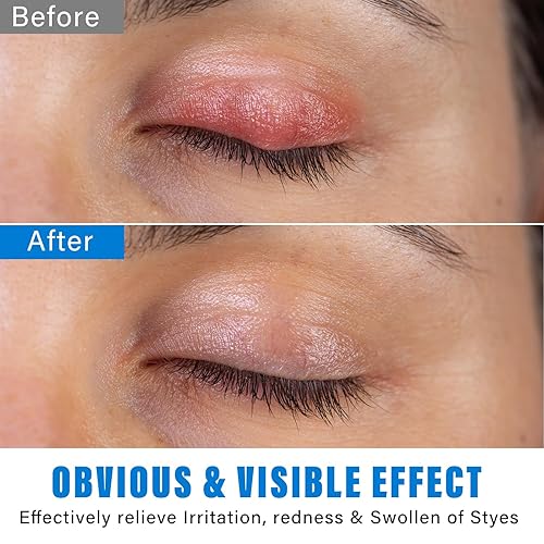 Miniatura 5 de VERYCOZY Tratamiento de ojos de orzuelo, alivio eficiente para los ojos de orzuelo para tratamiento de blefaritis y calazión, suero de alivio de