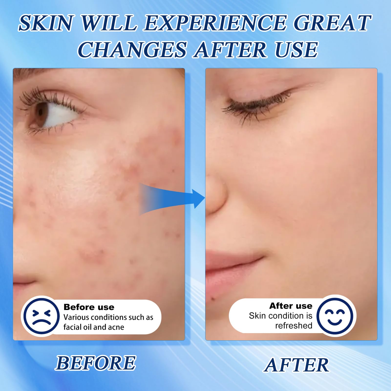 Acne Foaming Wash, pianka do głębokiego oczyszczania porów | Łagodny codzienny środek do mycia twarzy do głębokiego oczyszczania porów, przeciwpryszczowy płyn, do oczyszczania twarzy z