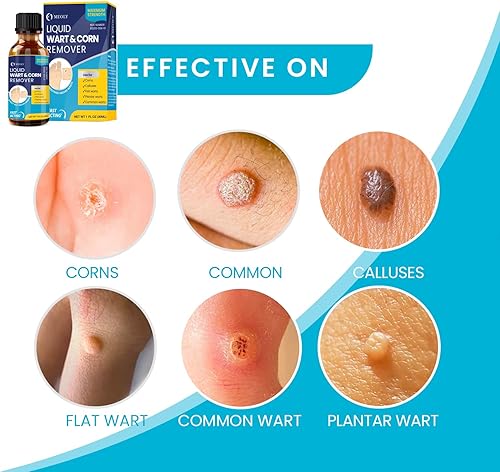 Miniatura 3 de Removedor de verrugas con ácido salicílico MEOLY Eliminación rápida de verrugas de máxima potencia para hombres y mujeres - Verruga plantar, verruga