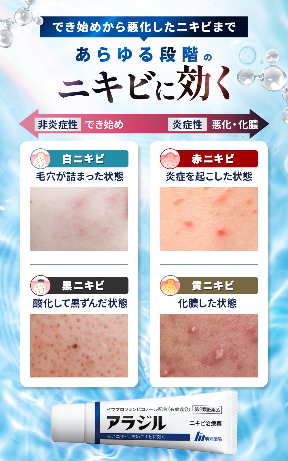 Amazon | 【第2類医薬品】アラジル ニキビ治療薬 24g | アラジル