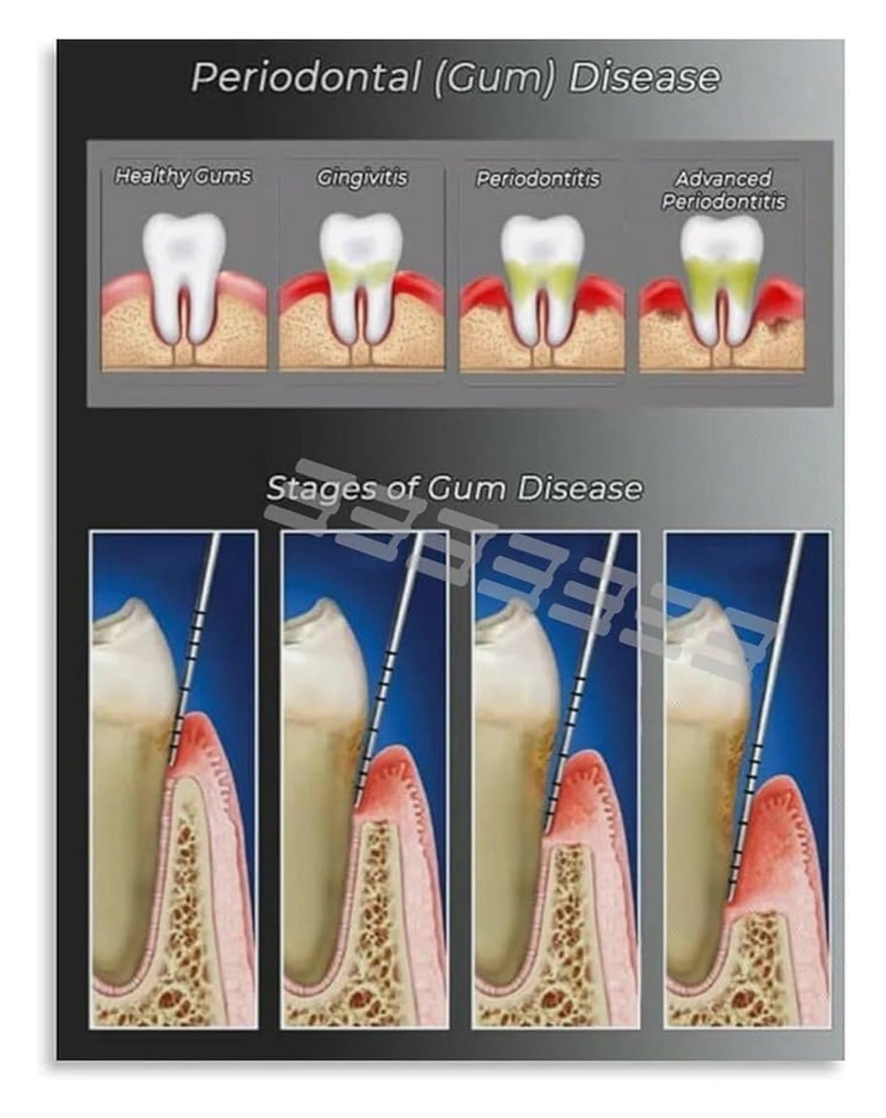 SSOPTMCB Scientific Diagram of Periodontal Disease Stages Educational Canvas Wall-Art for Home Decor(Framed,08x12inch(20x30cm))