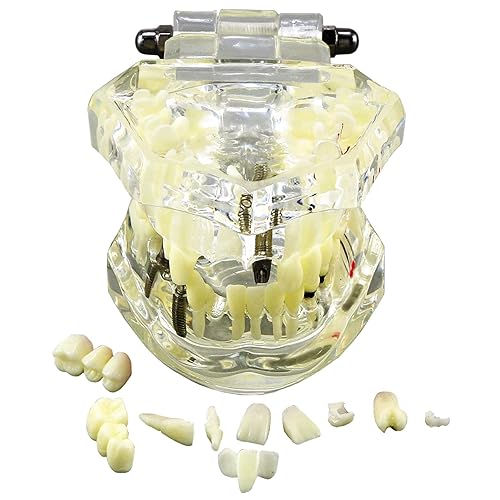 Miniatura 2 de Multifarious Tipos Modelo Dental Dientes Removibles Implante Ortodoncia Enseñanza Estudiar Modelos de demostración para Dentista Estudiante Escuela