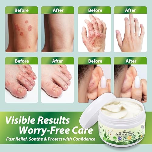 Miniatura 6 de Juego de champú para foliculitis y psoriasis del cuero cabelludo y crema de árbol de té para dermatitis seborreica, caspa, tiña e irritación