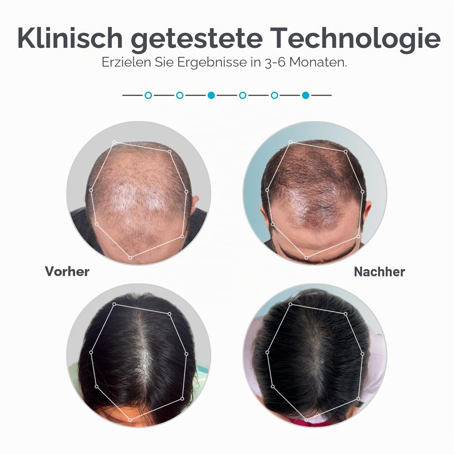 Capillus82 Mobile Lasertherapie-Mütze gegen Haarausfall - 6-min Modell mit flexibler Anpassung - FDA-Zulassung zur medizinischen Behandlung von androgenetischer Alopezie - Hervorragende Abdeckung