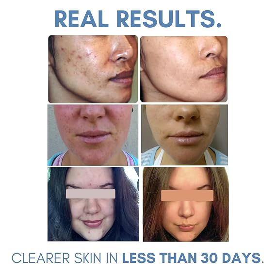 Clearogen Acne Lotion with Benzoyl Peroxide, Acne Cream, Face Moisturizer Acne Prone Skin, Acne Moisturizer for Face, 1.8 Fl oz