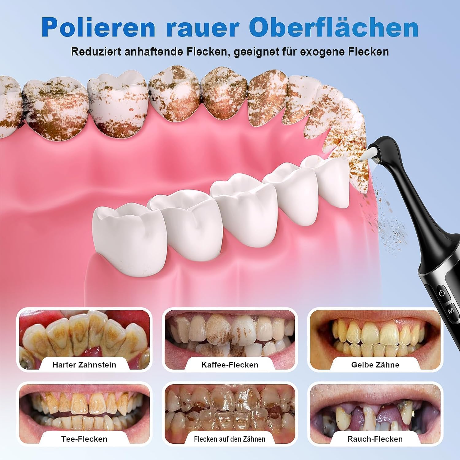 Zahnsteinentferner Zahnaufhellungsset, Zahnpolierer mit 5 Modi für Zahnreinigung & Zähne Aufhellen, zum Polieren nach der Zahnreinigung, Zahnaufhellung Bleaching Set mit 5 Köpfen