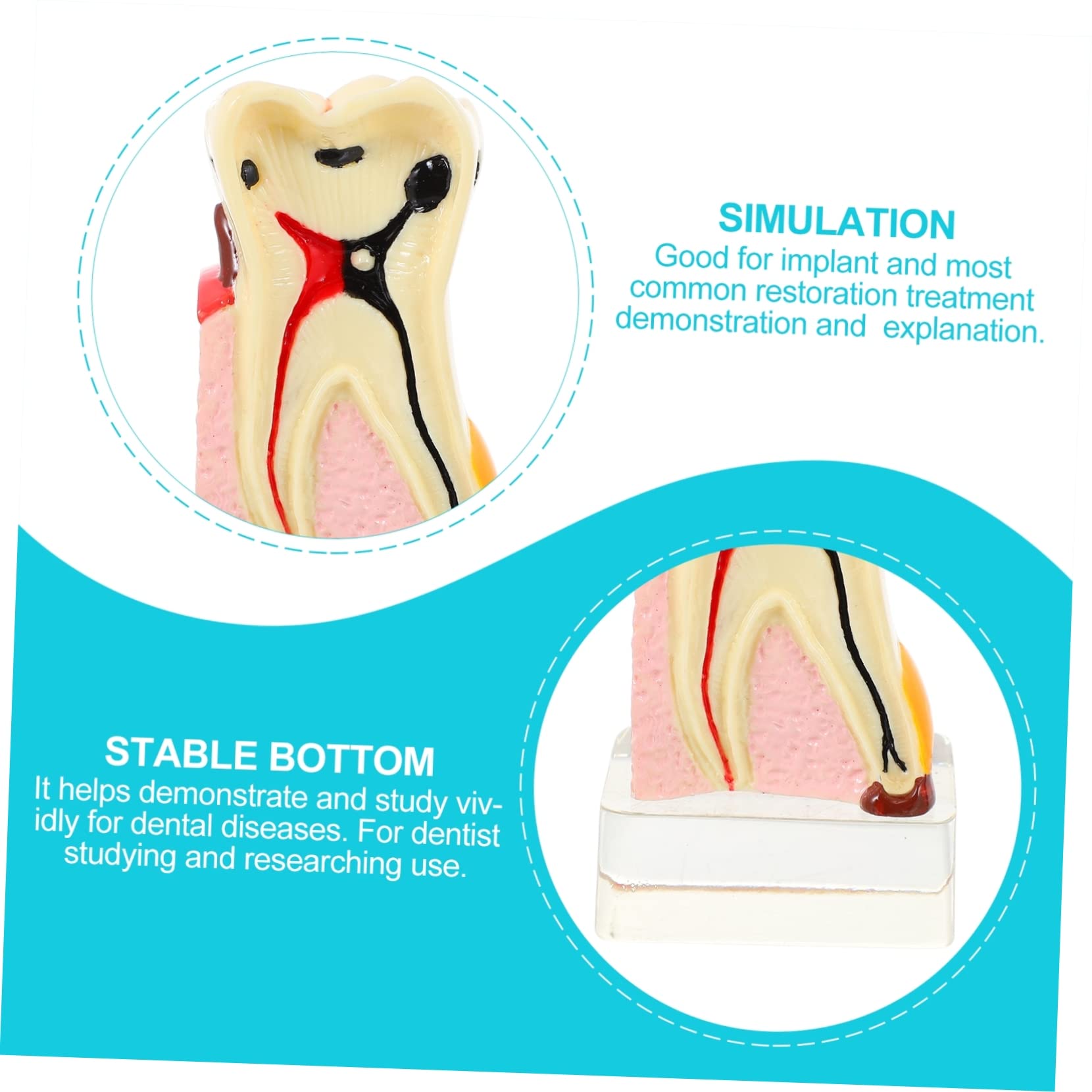 Modello Anatomico di Carie Dentale 4x in Resina Beige, Didattico | Dimostrazione e Insegnamento, Leggero e Portatile, per Odontoiatra, Uso Professionale in Studio