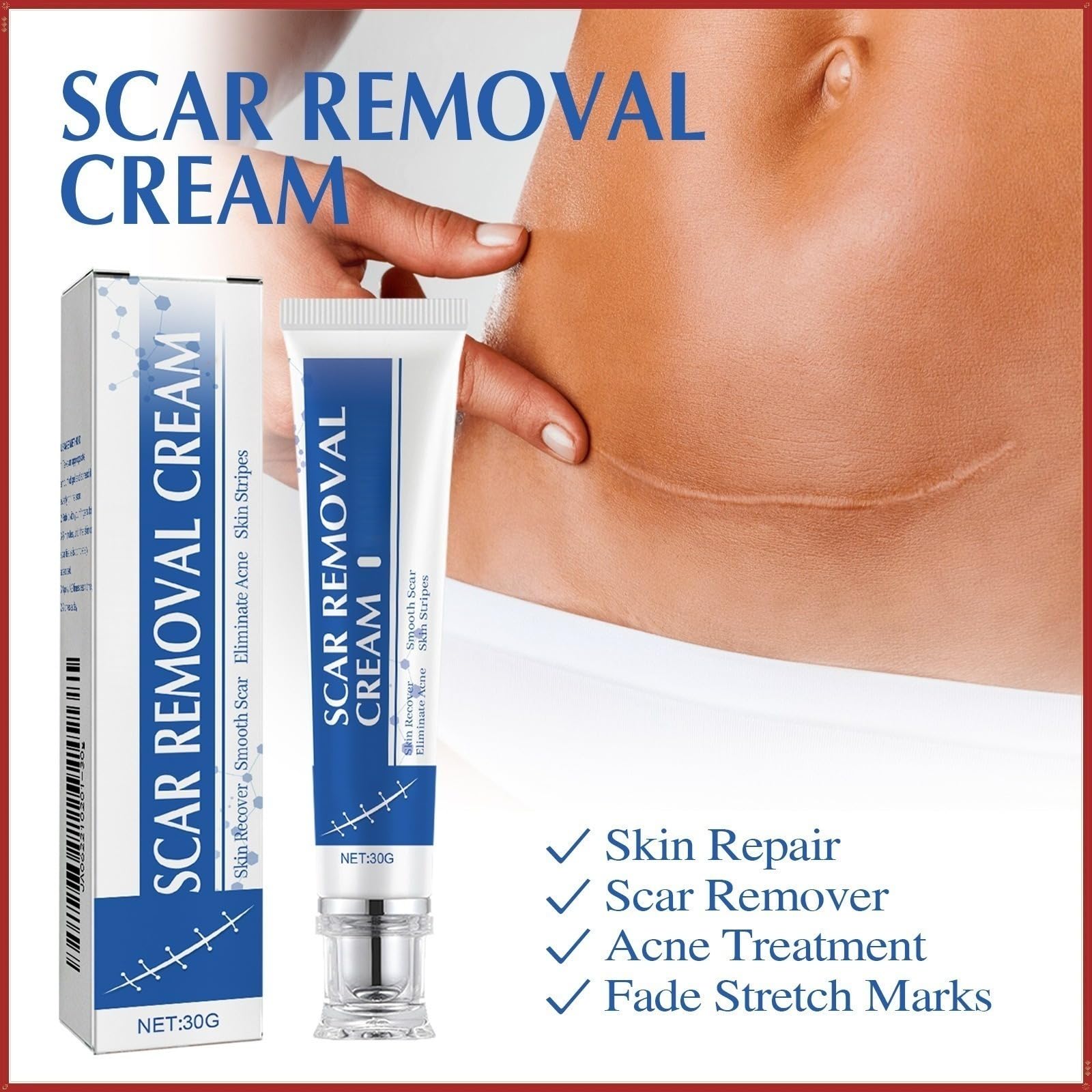 Crème anti-cicatrices, aide à réduire l'apparence des anciennes et nouvelles, Stretch Marks, Keloids, Wounds traitement des pour le visage et le corps, réparatrice pour cicatrices, césarienne, chirur