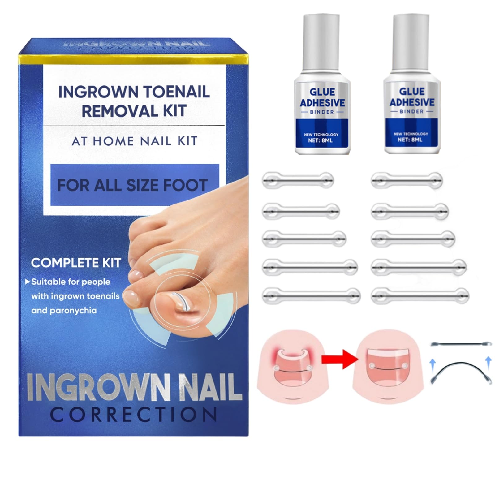Ingrown Toenail Treatment, Reusable Ingrown Toenail Removal Kit for All Size Foot, Ingrown Toenail Corrector for Curved Nail at Home