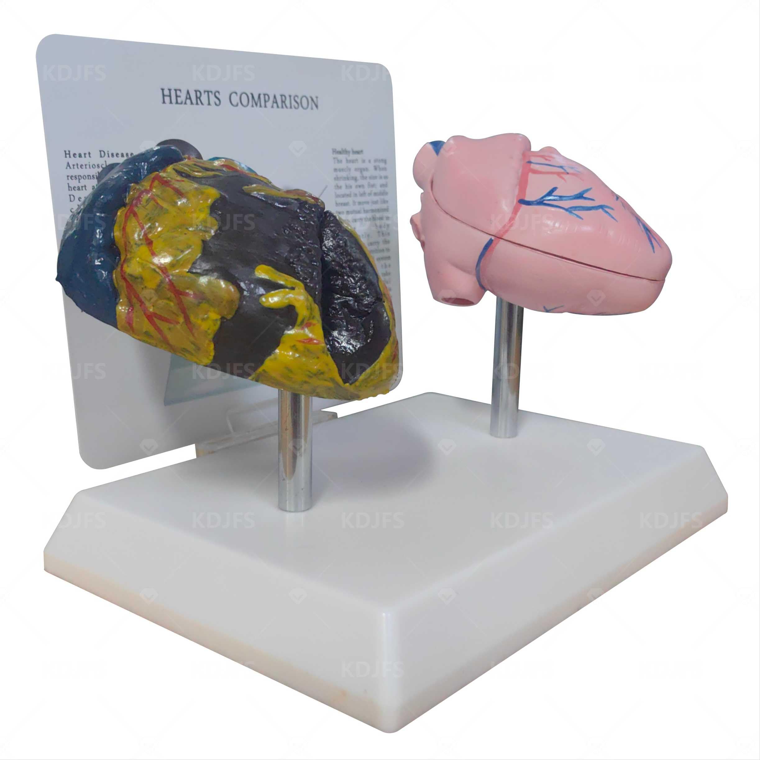 Raucher Herz Modell + Gesundes Herzmodell Mit Pathologische Merkmale Und Klare Textur Genaue Anatomische Struktur Rauchens Auf Die Herzgesundheit Zu Demonstrieren
