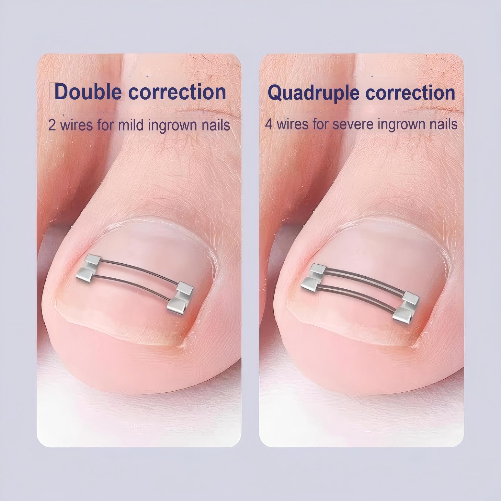 Cuttable Adjustable Titanium Alloy Silicone Ingrown Correction Kit,Ingrown Toenail Treatment,Ingrown Toenail Removal Kit,Designed for Ingrown Nail Repair,Ingrown Toenail Corrector at Home,reusable