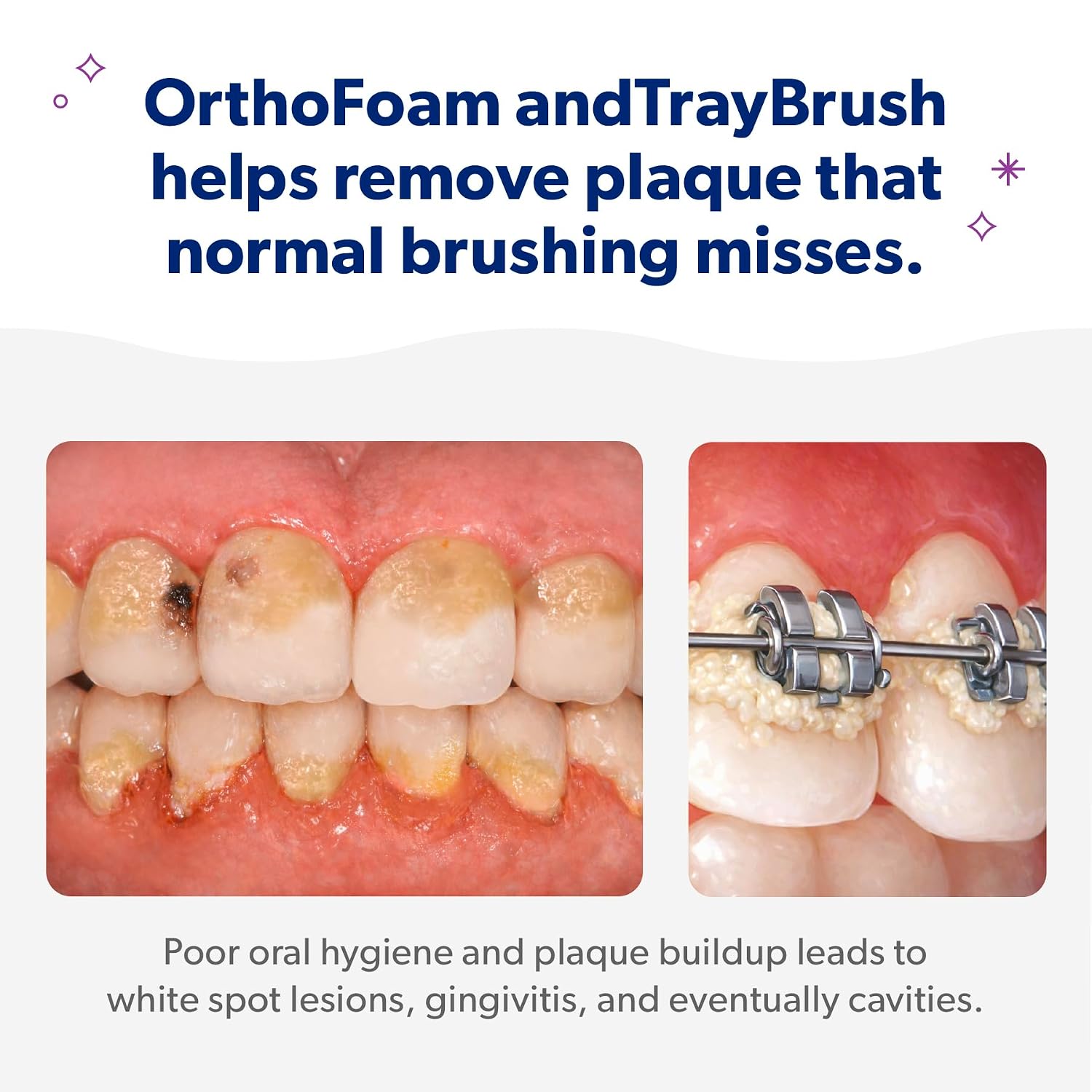 EverSmile Braces Care Bundle for Adults: OrthoFoam (50ml) + TrayBrush U-Shaped Toothbrush – Deeply Cleans All Your Teeth & Gums at Once, Even Under Metal & Ceramic Braces, Brackets & Wires