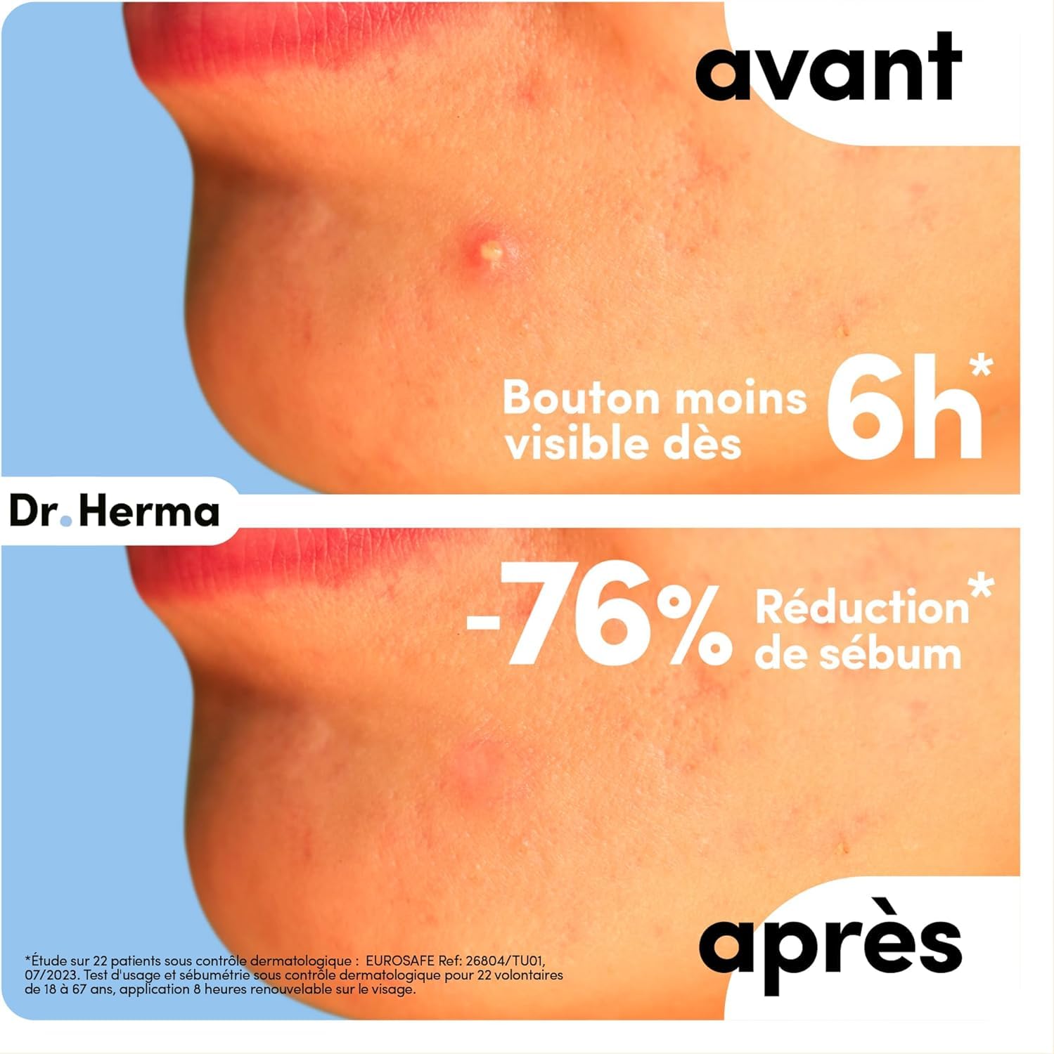 Dr. Herma – Anti-Pickel-Patches, Unsichtbare Anti-Akne-Patches – Sichtbare Ergebnisse in 6–8 Stunden – Dermatologisch getestet – 2 Packungen mit je 24 Patches