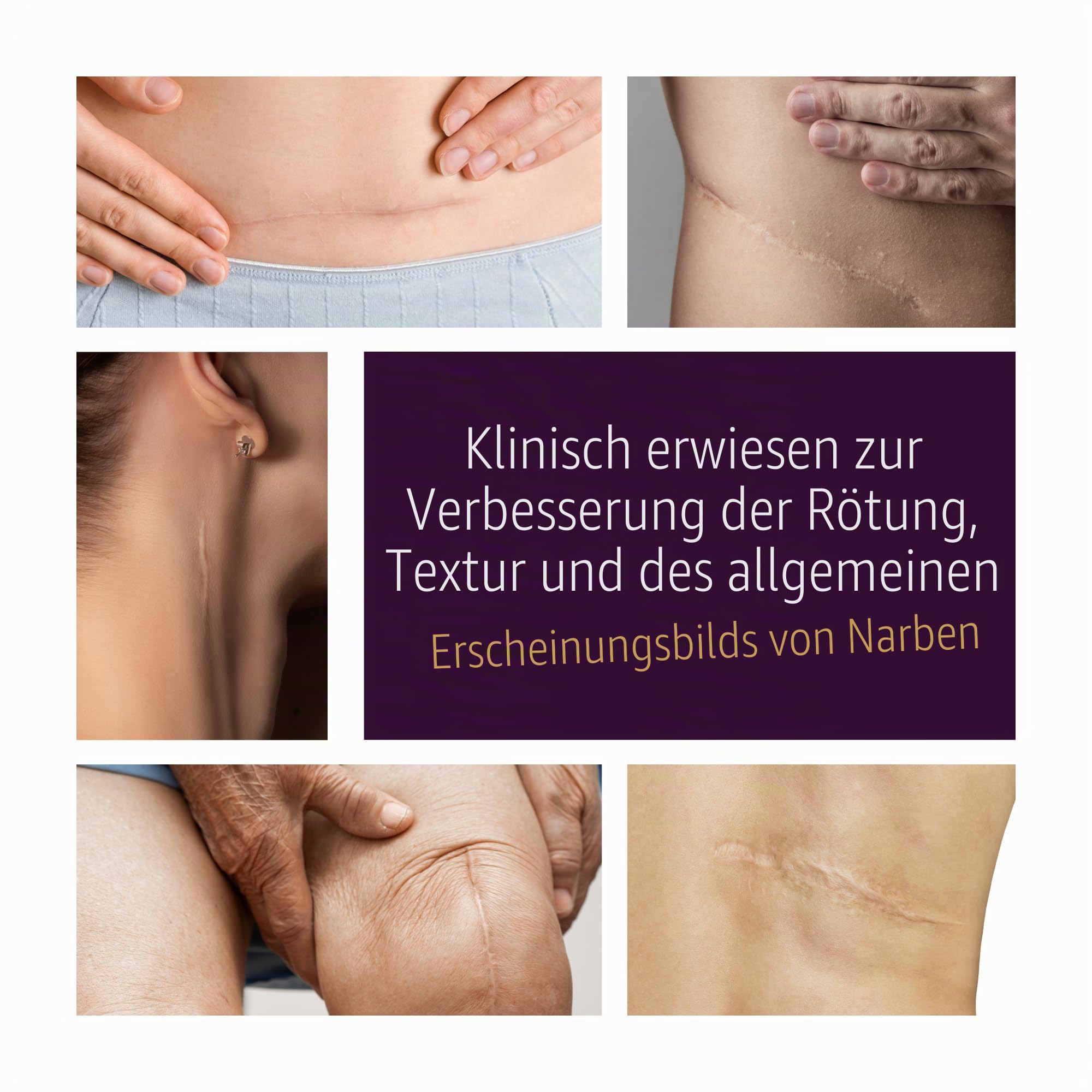 Mederma Advanced Narbengel, 1 x täglich, reduziert das Erscheinungsbild von alten neuen Narben, Nr. 1, von Ärzten empfohlene Marke für Narben, 50 g