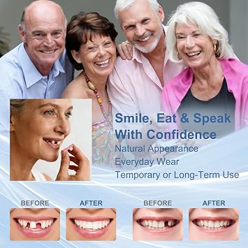 Custom Partial Dentures for Missing Tooth (4 Teeth)