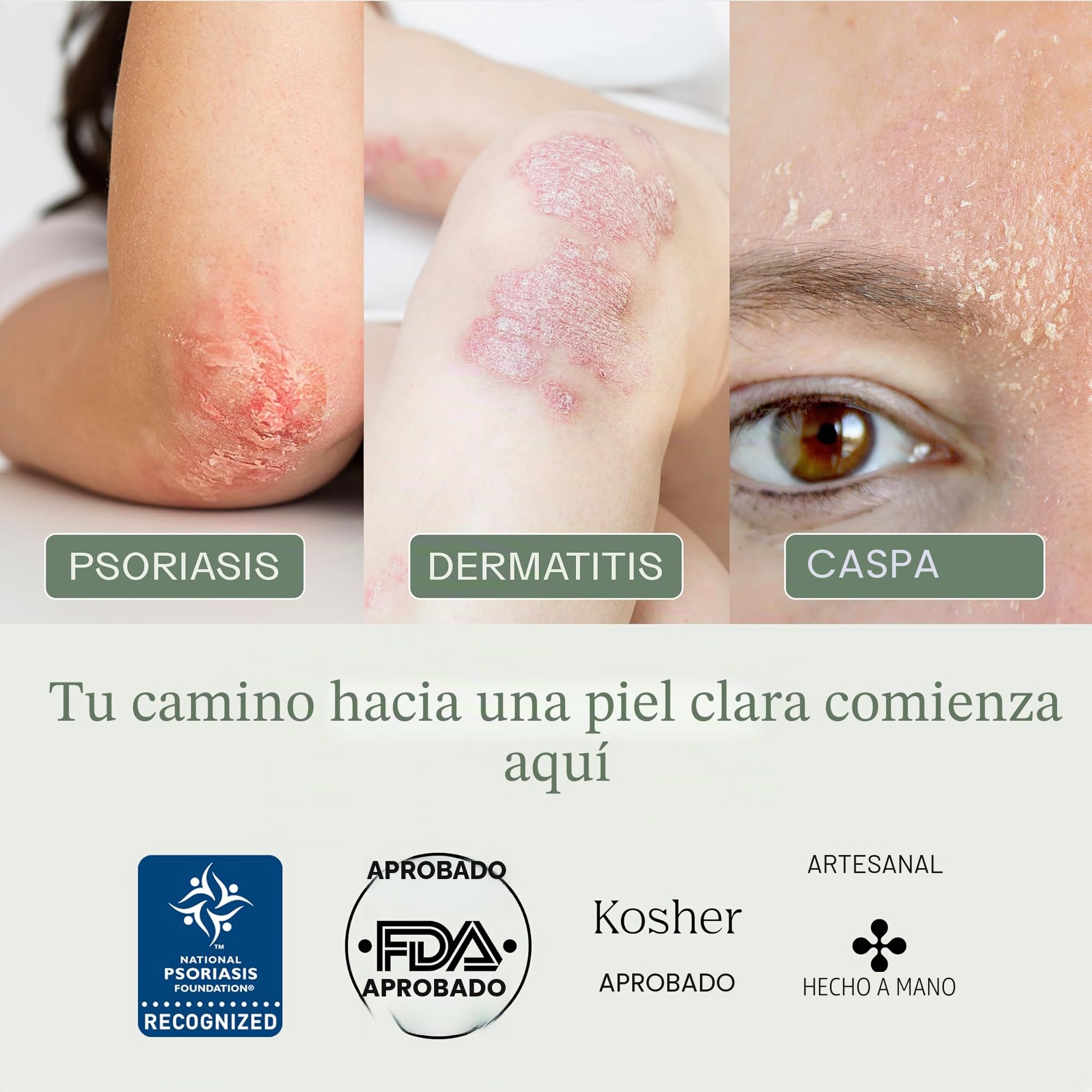 Dermabon Jabón limpiador de psoriasis, dermatitis seborreica y eccema para adultos, 2% de jabón de alquitrán de hulla, alivia la picazón, reduce la inflamación, hidrata la piel, uso diario suave,