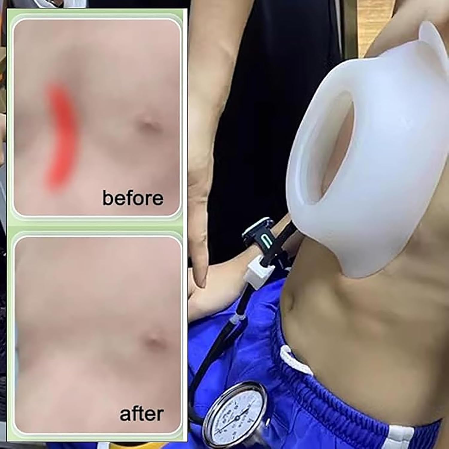 Pectus Excavatum Orthosis Brace,Pectus Excavatum Vacuum Bell,Pectus Excavatum Orthosis Brace,Chest Support,w/Pressure Gauge, Sternal Depression (121)