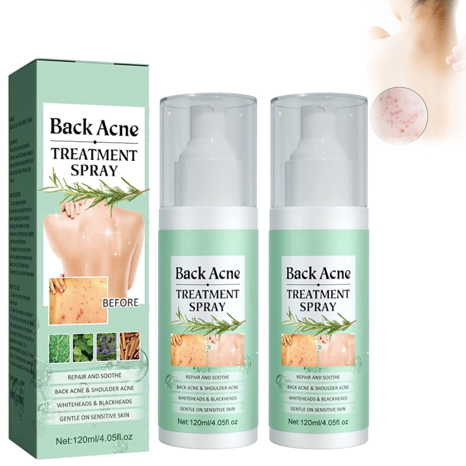 Herbaluxy Back Acne,Back Acne Treatment Spray,Deep Clean