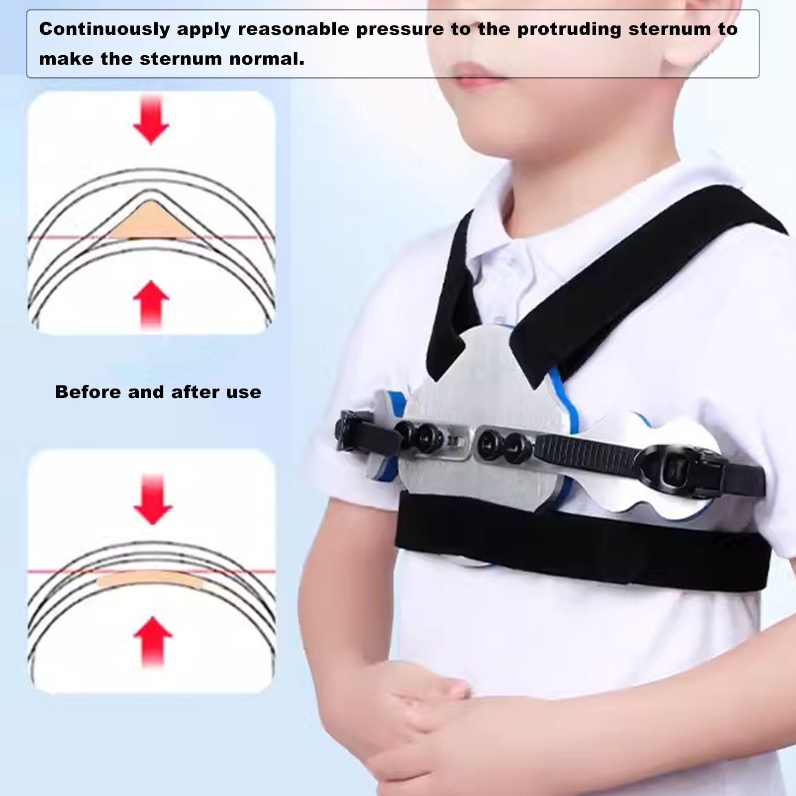 Ortesis para Pectus carinatum: Soporte torácico de Paloma para niños, ortesis para esternón deformado, ortesis para Costillas valgas, tamaño Ajustable, Transpirable(A)
