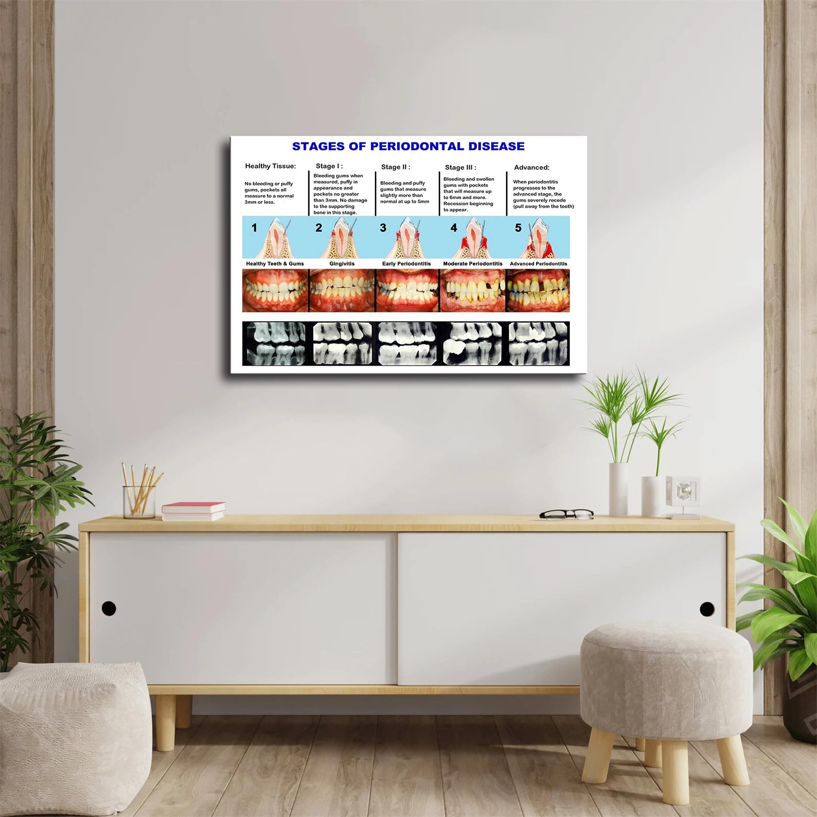 Dental Clinic Wall Poster Periodontal Disease Staging Chart Poster Modern Family Bedroom Office Background Wall Art HD Picture Canvas Printing Artwork Decor (16×24inch-No Framed)