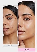 Vista 6 de EasyDerm - Juego de parches coreanos para espinillas en 4 pasos + extractor de doble punta 2 en 1, para un cuidado completo de la piel