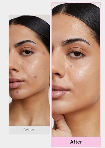 Miniatura 6 de EasyDerm - Juego de parches coreanos para espinillas en 4 pasos + extractor de doble punta 2 en 1, para un cuidado completo de la piel