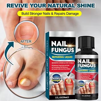 Extra Strong Fungal Nail Treatment for Toenails & Fingernails, Formula Extra Strong Antifungal to Repair & Renew Thick Damaged Nails, Restore Healthy Nails, promoting natural growth, 30 ml