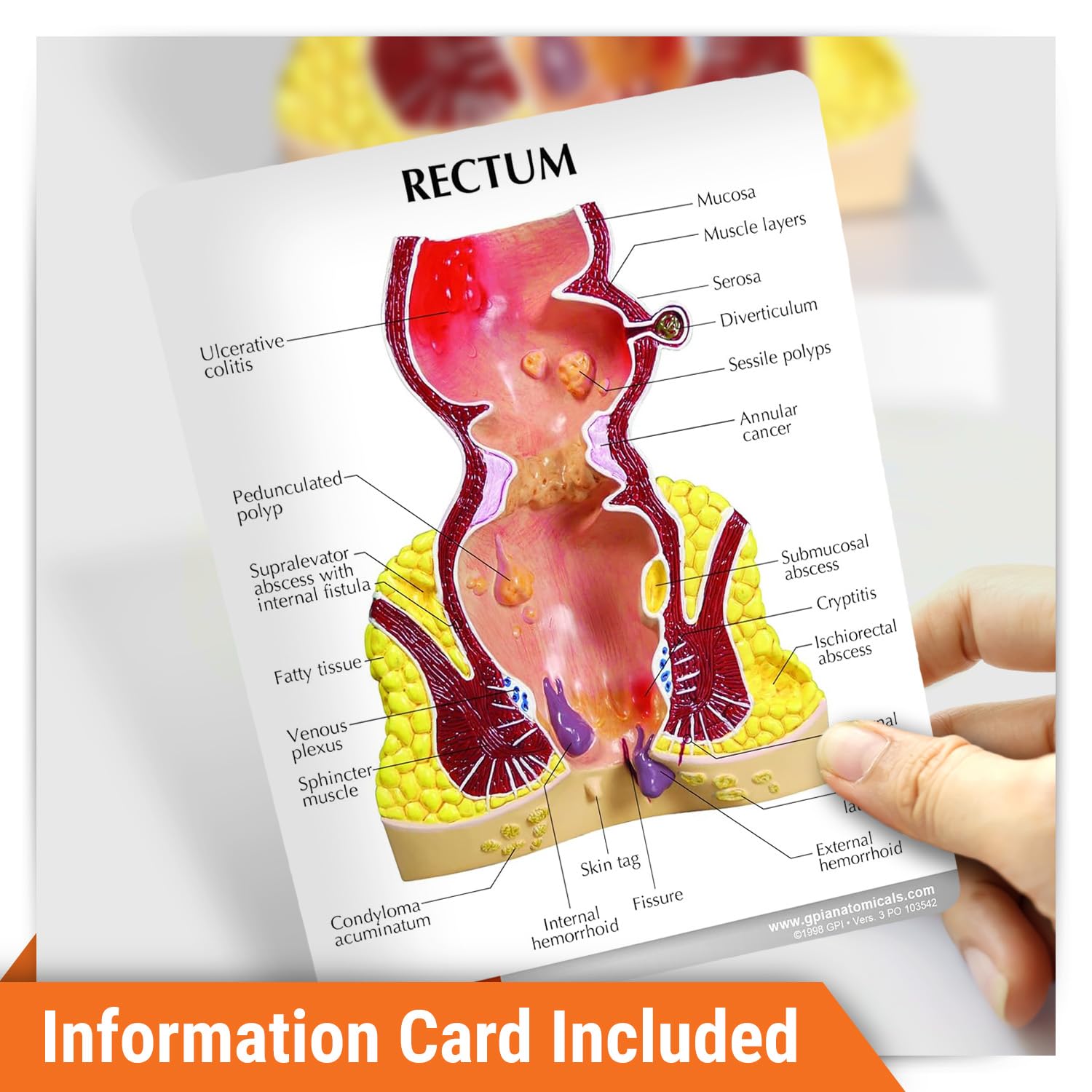 GPI Anatomicals - Human Rectum Model with Common Pathologies, Replica for Anatomy and Physiology Education, Anatomy Model for Doctor's Offices and Classrooms, Medical Learning Resources