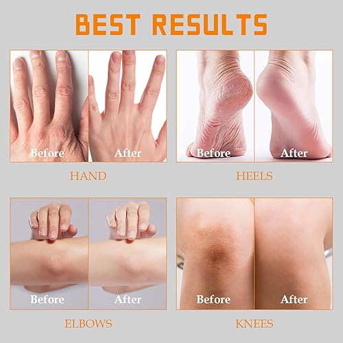 Miniatura 4 de YOUNGYOUNGLOVE Crema de urea 60% sin fragancia más 2% ácido salicílico, para manos secas agrietadas, rodillas, pies, talones, crema de pies sin