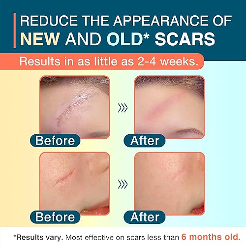 Miniatura 2 de Hojas de silicona para cicatrices, 1.55" x 156" - 4M, rollo de cinta de silicona médica para cicatrices, tiras de cicatrices reutilizables para