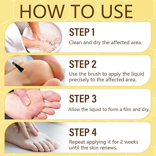 Miniatura 6 de SUVNUFK Removedor de verrugas de veneno de abeja, congelación de verrugas de acción rápida con 12% de ácido salicílico, removedor líquido de marcas